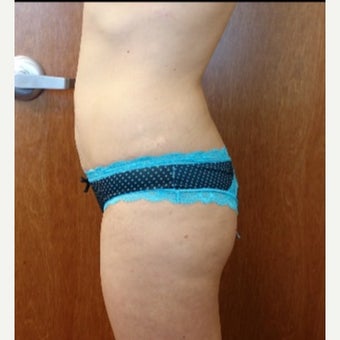 25-34 year old woman treated with Butt Implants and Fat Transfer before 2342502