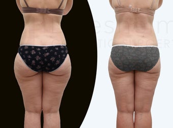 37 year old women body jet liposuction to remove fat and shaping of thighs before 1127707