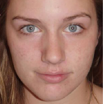 18-24 year old woman treated with TCA Peel after 3384399