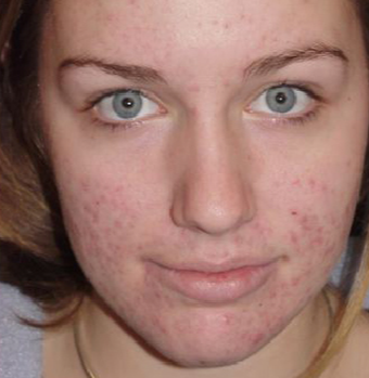 18-24 year old woman treated with TCA Peel before 3384399