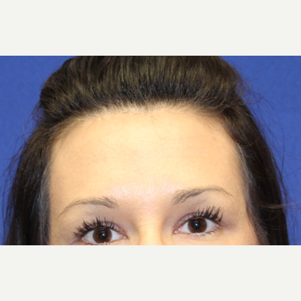 32 year old woman treated with Botox to her forhead after 3737389