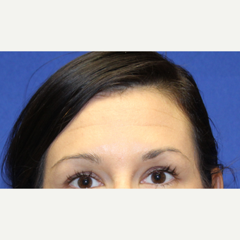 32 year old woman treated with Botox to her forhead before 3737389