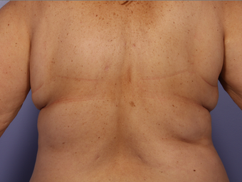 CoolSculpting by Zeltiq to Bra Rolls before 375509