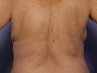 CoolSculpting by Zeltiq to Bra Rolls after 375509