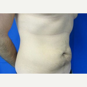 Liposuction before 3001138