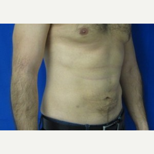 Liposuction after 3001138