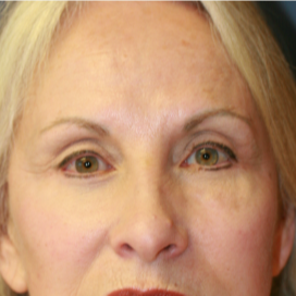 55-64 year old woman treated with Eyelid Surgery after 3560840