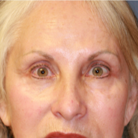 55-64 year old woman treated with Eyelid Surgery before 3560840