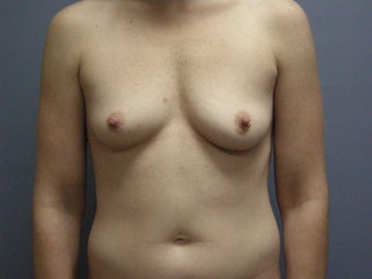Breast Augmentation For 32-year-old Woman before 1117558