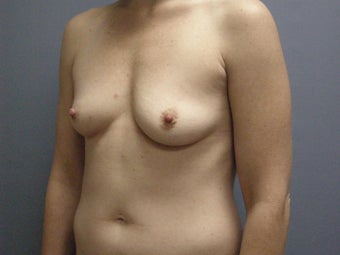 Breast Augmentation For 32-year-old Woman 1117558