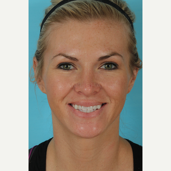 25-34 year old woman treated with Rhinoplasty after 3690999