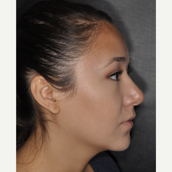 18-24 year old woman treated with Rhinoplasty 1 year post-op after 3708687