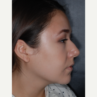 18-24 year old woman treated with Rhinoplasty 1 year post-op before 3708687