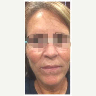65-74 year old woman treated with Kybella after 3284195