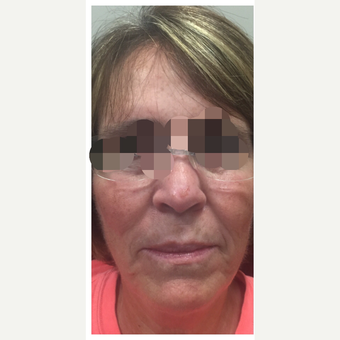 65-74 year old woman treated with Kybella before 3284195