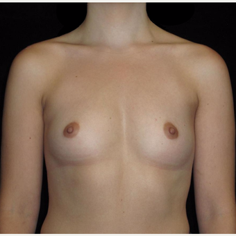 24 year old woman treated with Breast Augmentation before 3802761
