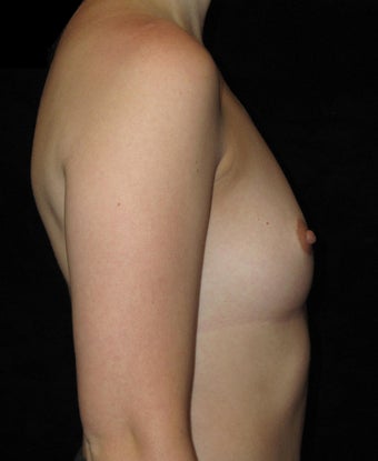 24 year old woman treated with Breast Augmentation 3802761