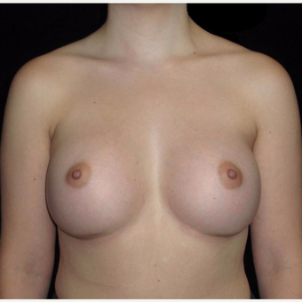 24 year old woman treated with Breast Augmentation after 3802761