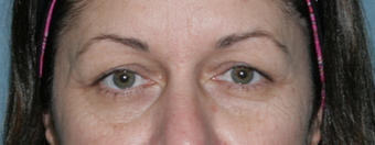 Fraxel Repair Treatment Around Eyes 1064625