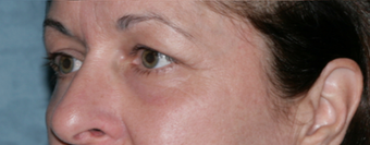 Fraxel Repair Treatment Around Eyes after 1064625