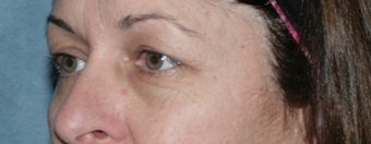 Fraxel Repair Treatment Around Eyes before 1064625