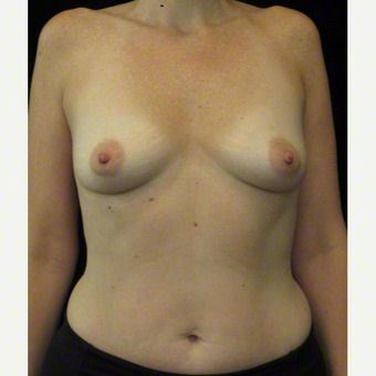 40 year old woman treated with Breast Augmentation before 3103633
