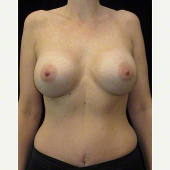 40 year old woman treated with Breast Augmentation after 3103633