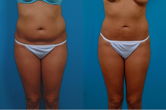 24-year-old woman treated with Liposuction. before 574497