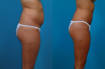 24-year-old woman treated with Liposuction. after 574497