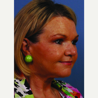 55-64 year old woman treated with Facelift after 3696918