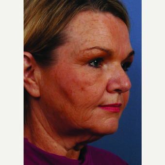 55-64 year old woman treated with Facelift before 3696918