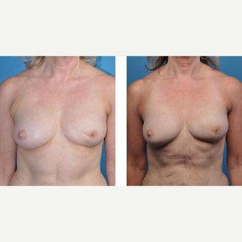 57 year old woman treated with Breast Reconstruction before 2524335