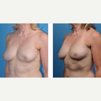 57 year old woman treated with Breast Reconstruction after 2524335