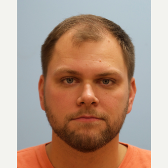 25-34 year old man treated with FUE Hair Transplant before 3091820