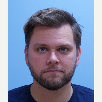 25-34 year old man treated with FUE Hair Transplant after 3091820