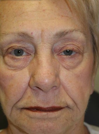 65-74 year old woman treated with Eyelid Surgery before 3227764