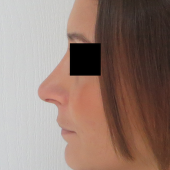 25-34 year old woman treated with Rhinoplasty after 3511036