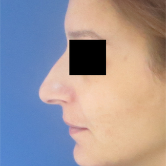 25-34 year old woman treated with Rhinoplasty before 3511036