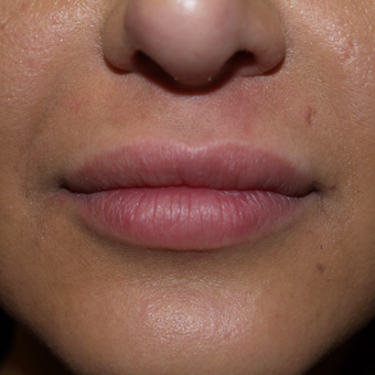 25-34 year old woman treated with Lip Augmentation after 3668762
