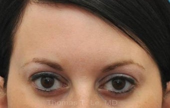 Botox for treatment of upper face wrinkles after 1022034
