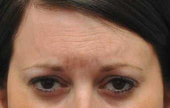 Botox for treatment of upper face wrinkles before 1022034