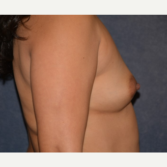 35-44 year old woman treated with Breast Augmentation before 3455169