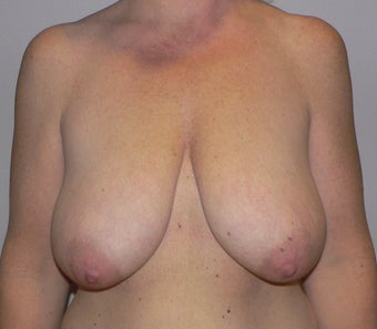 49 year old woman has Breast Lift before 990736