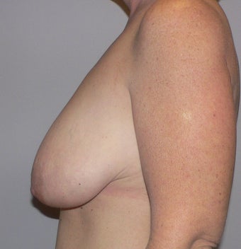 49 year old woman has Breast Lift 990736