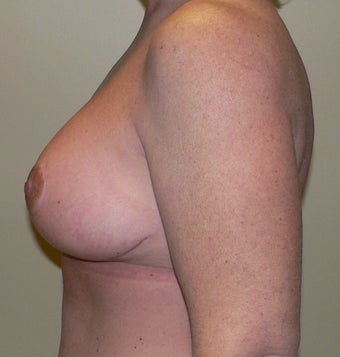 49 year old woman has Breast Lift 990736