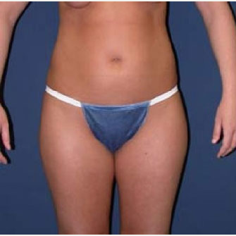 35-44 year old woman treated with SAFELipo before 3126360