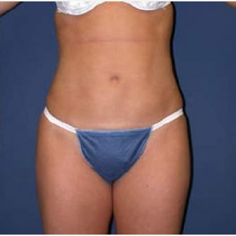 35-44 year old woman treated with SAFELipo after 3126360