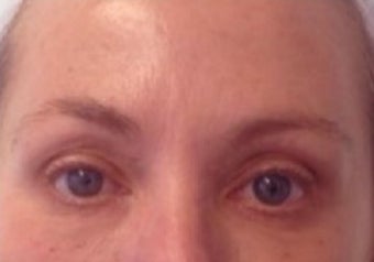 45-54 year old woman treated with Exilis after 2487426