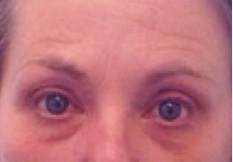 45-54 year old woman treated with Exilis before 2487426