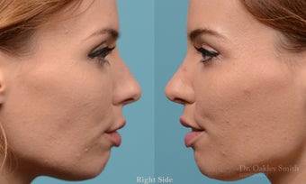 25-34 year old woman treated with Rhinoplasty 3615762